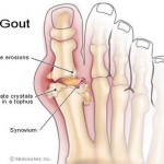 Rates of gout in UK soaring photo